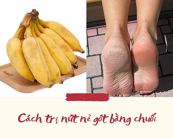 Lộ bàn chân sần sùi khi mang giày hở gót, áp dụng ngay cách trị nứt nẻ gót chân này